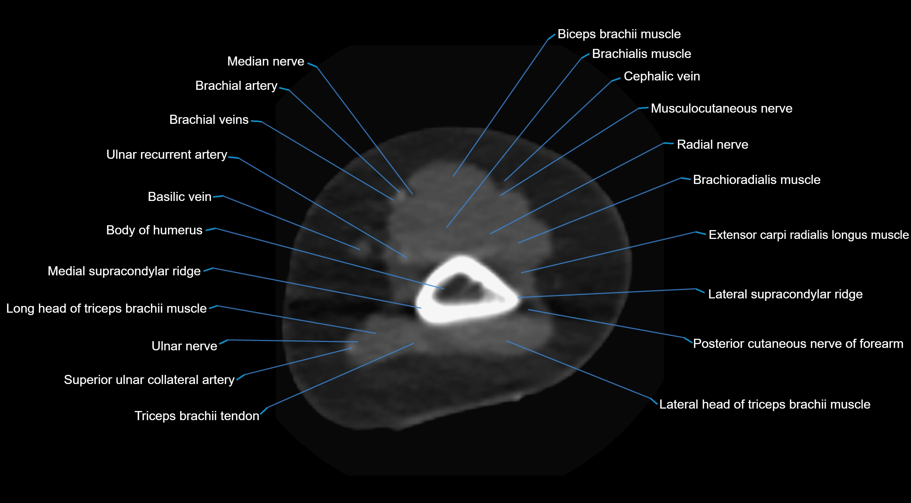 CT elbow axial  cross sectional anatomy labelled  radiology image -00002.webp